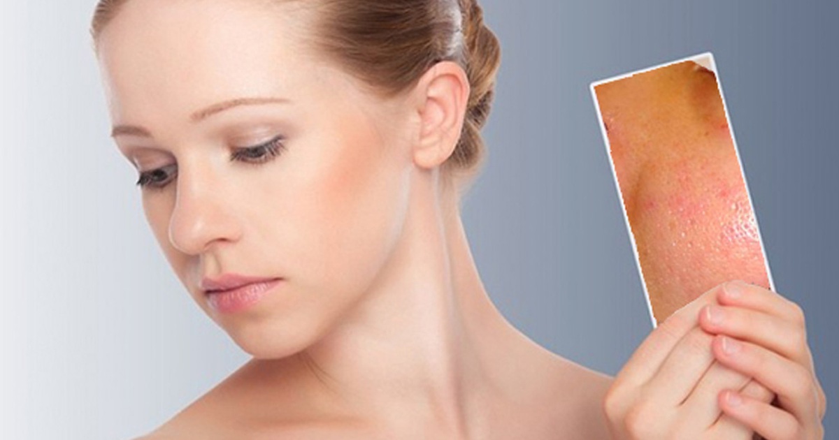 Học cách rửa mặt ‘chuẩn’ cho da nhờn và mụn