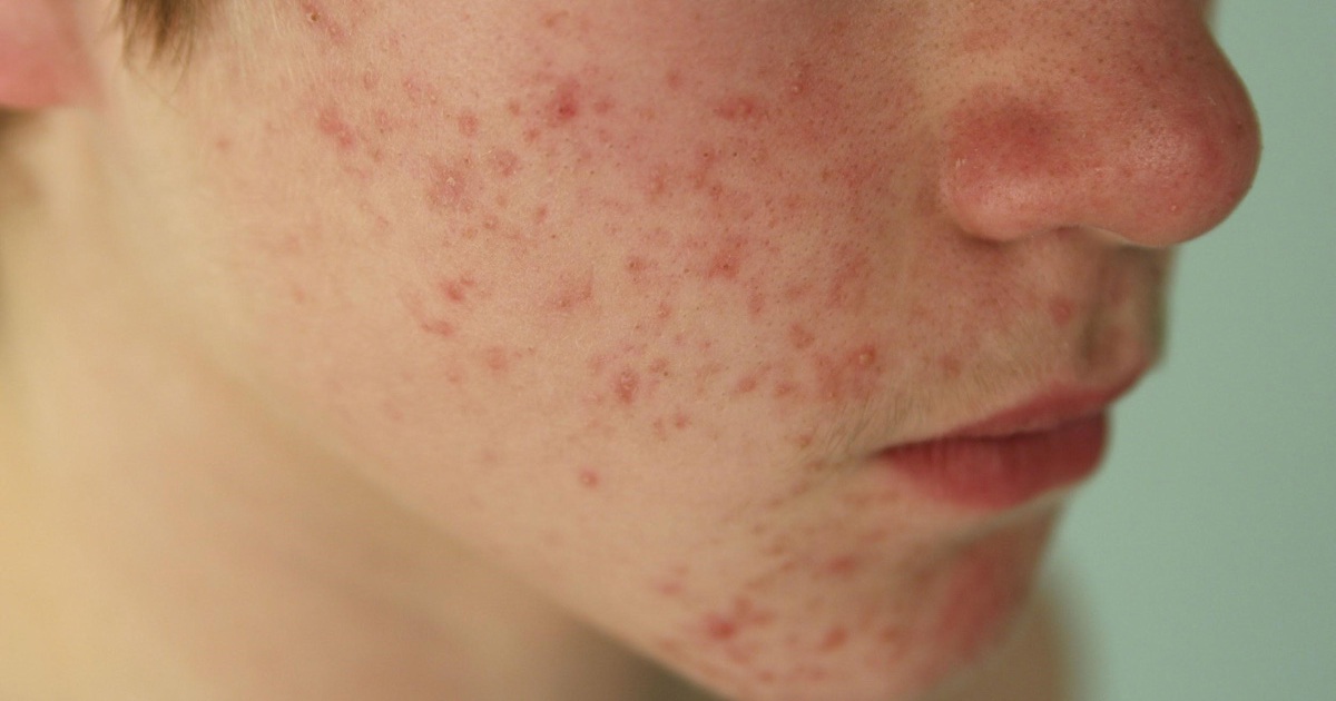 Mụn tuổi dậy thì trị mãi không hết: Phải làm sao?