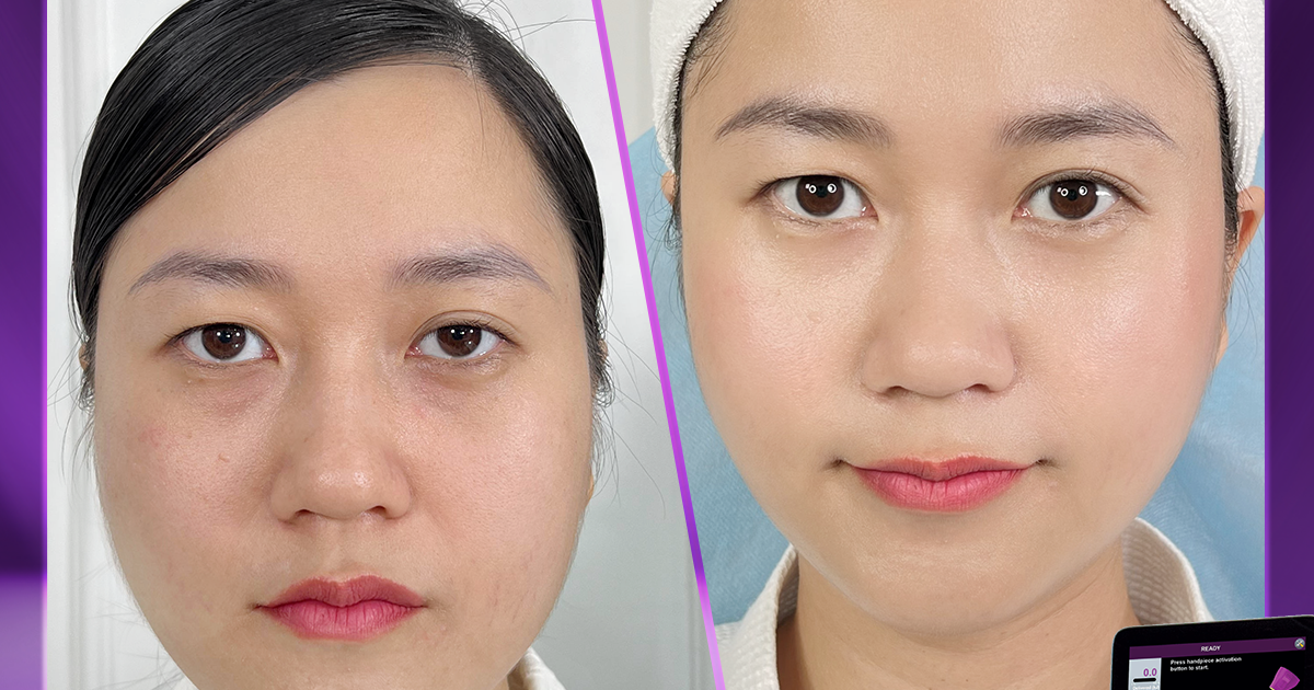 Doctor Beauty giúp Lâm Vỹ Dạ xóa nhăn cấp tốc