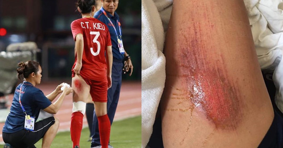 VFF lo trọn chi phí Chương Thị Kiều sang Hàn Quốc mổ như Xuân Trường