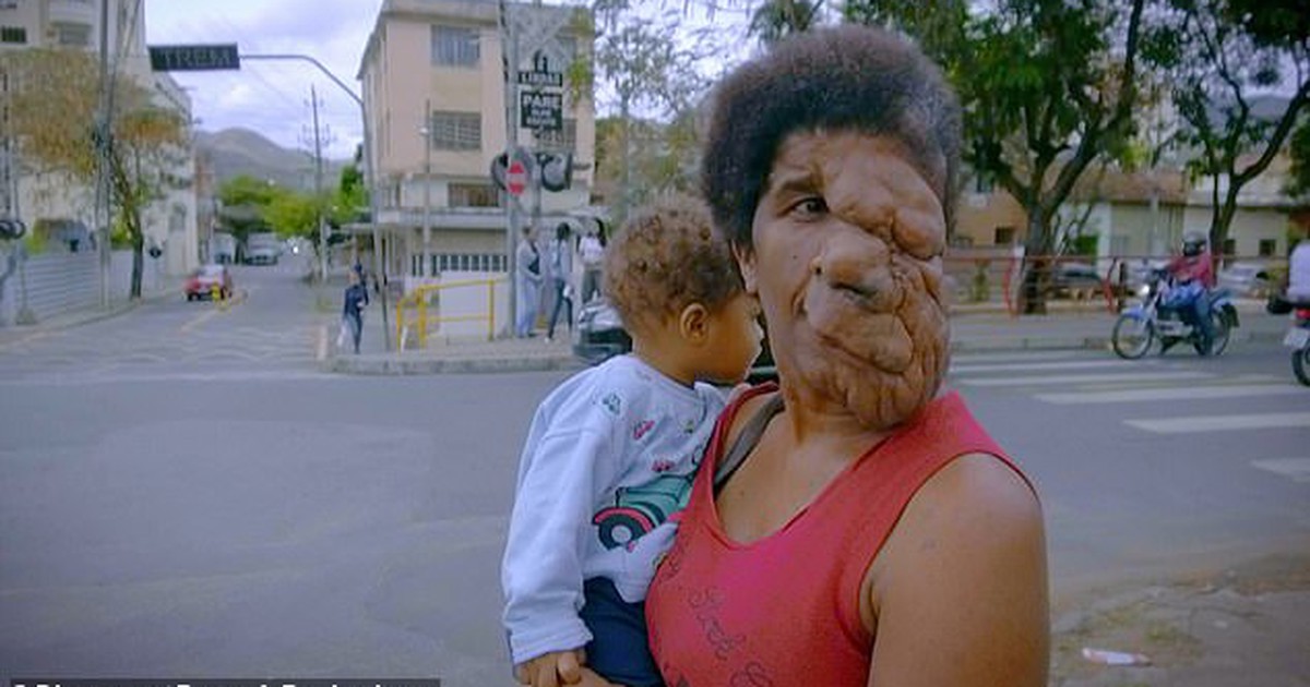 Người phụ nữ vẫn vui sống dù mang khối u khổng lồ che gần hết mặt