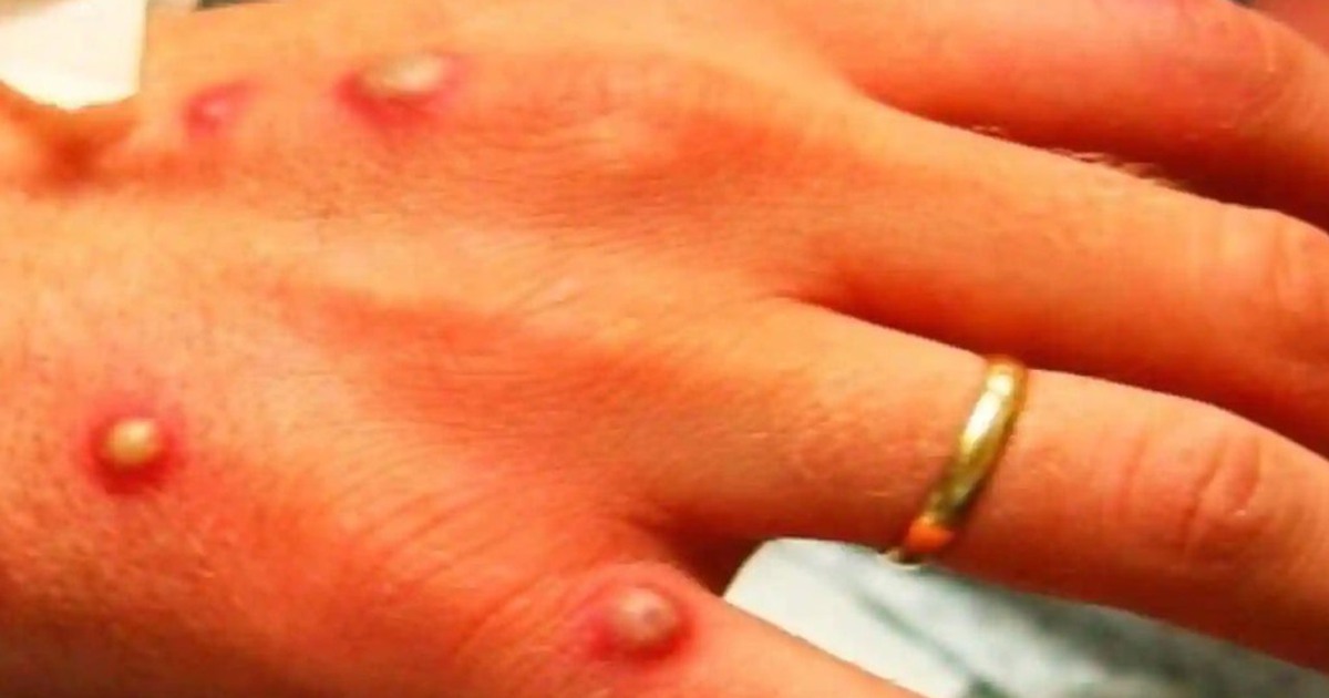 Mỹ cảnh báo đậu mùa khỉ đã âm thầm lây lan từ lâu