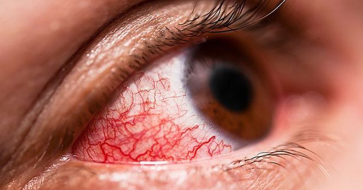 Virus gây xuất huyết ở mắt lan đến châu Âu, tỷ lệ tử vong đến 40%