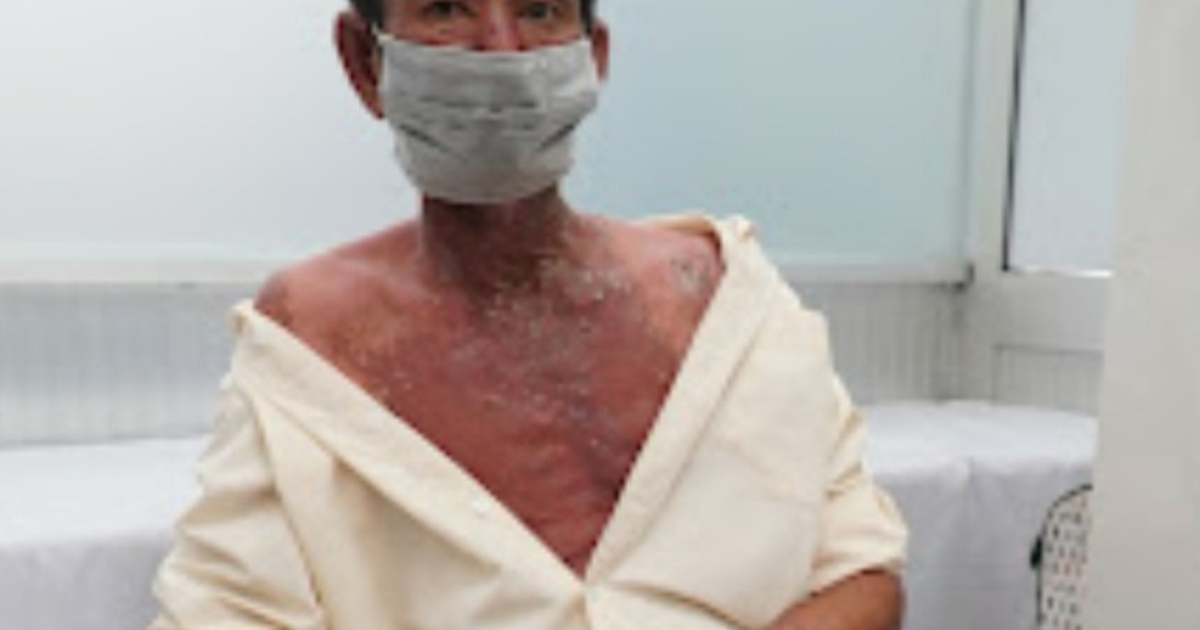 Người đàn ông bị nhiễm độc, phồng rộp toàn thân vì thuốc diệt cỏ