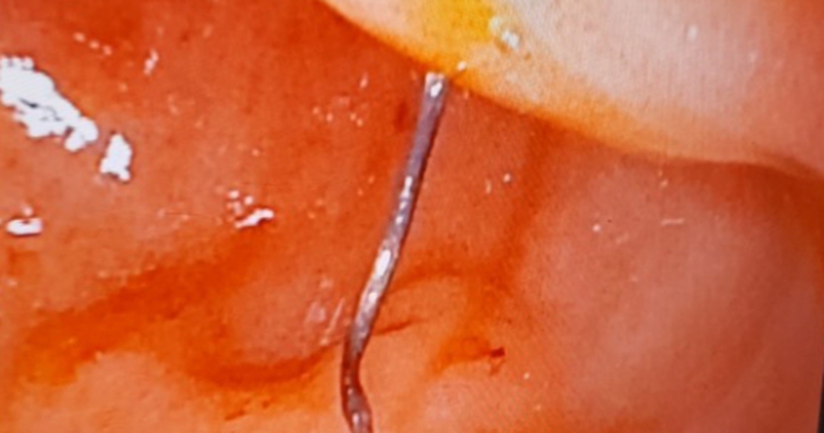 Gắp sợi dây chì dài 3 cm ra khỏi dạ dày bệnh nhân