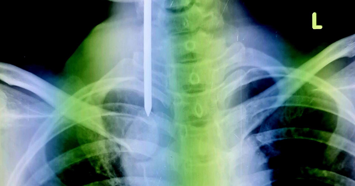 Phẫu thuật giữa đêm lấy cây đinh dài 8 cm ra khỏi vùng cổ bệnh nhân