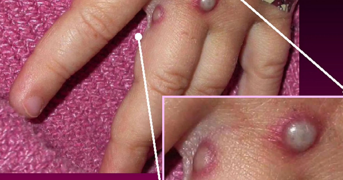 Bệnh đậu mùa khỉ đã xuất hiện ở Singapore, Hàn Quốc