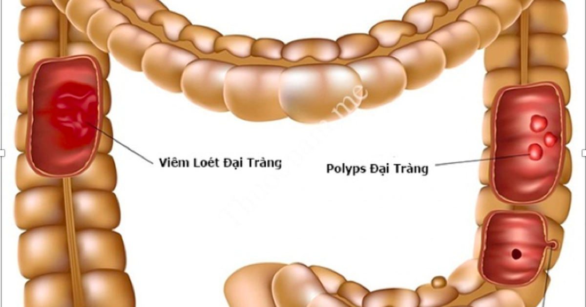 Ung thư đại trực tràng phổ biến nhưng có đáng sợ?