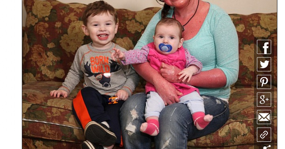 Những người mắc bệnh lạ: Cô gái 'người đỏ' lấy chồng, sinh con kỳ diệu