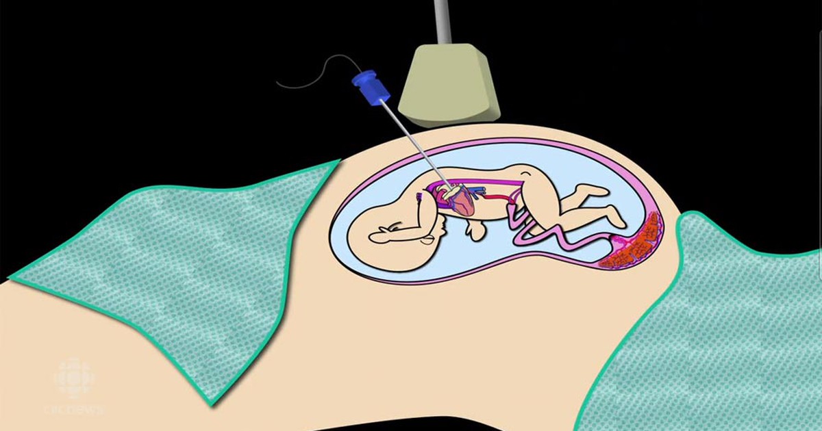 Phẫu thuật tim cứu sống thai nhi ngay trong bụng mẹ