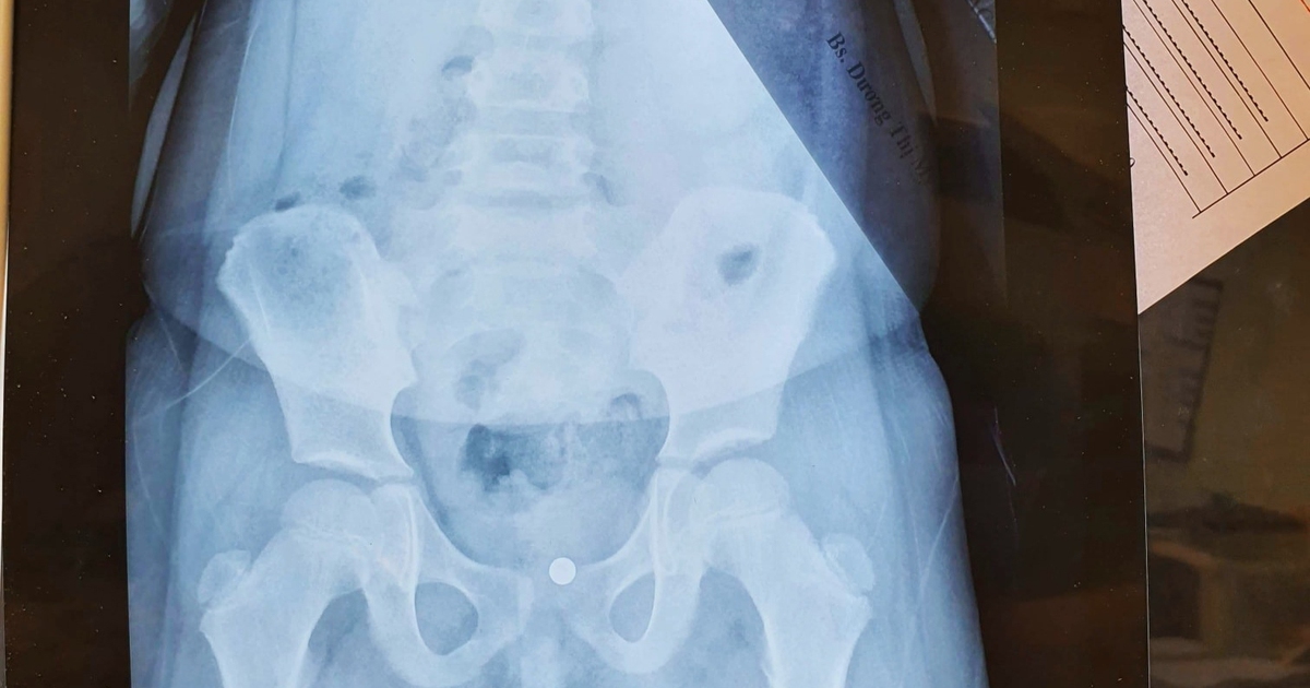 Nghịch dại cho viên bi vào vùng kín, bé gái phải cấp cứu, nội soi gắp ra