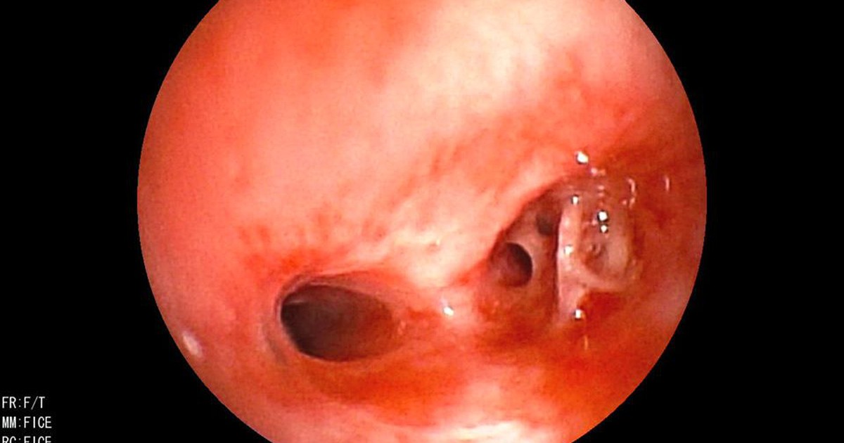 Ăn dặm cháo lươn, em bé hóc nguyên đốt xương vào phổi, nguy kịch