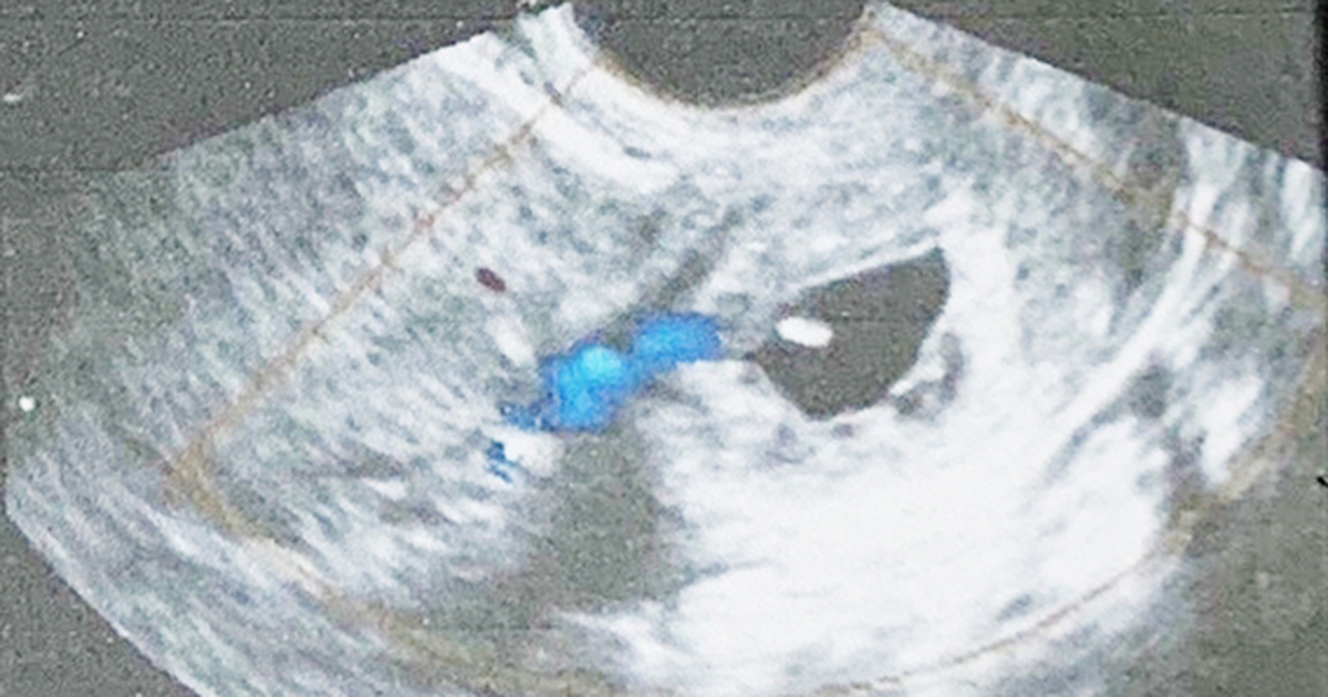 Thai sống ở cổ tử cung hiếm gặp, bác sĩ buộc phải hủy thai, cứu mẹ