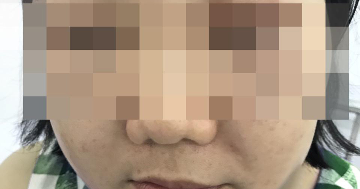 ‘Tiền mất tật mang’ sau khi tiêm ‘tế bào gốc’ làm đẹp da