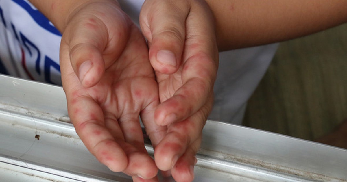 TP.HCM báo động bệnh tay chân miệng gia tăng