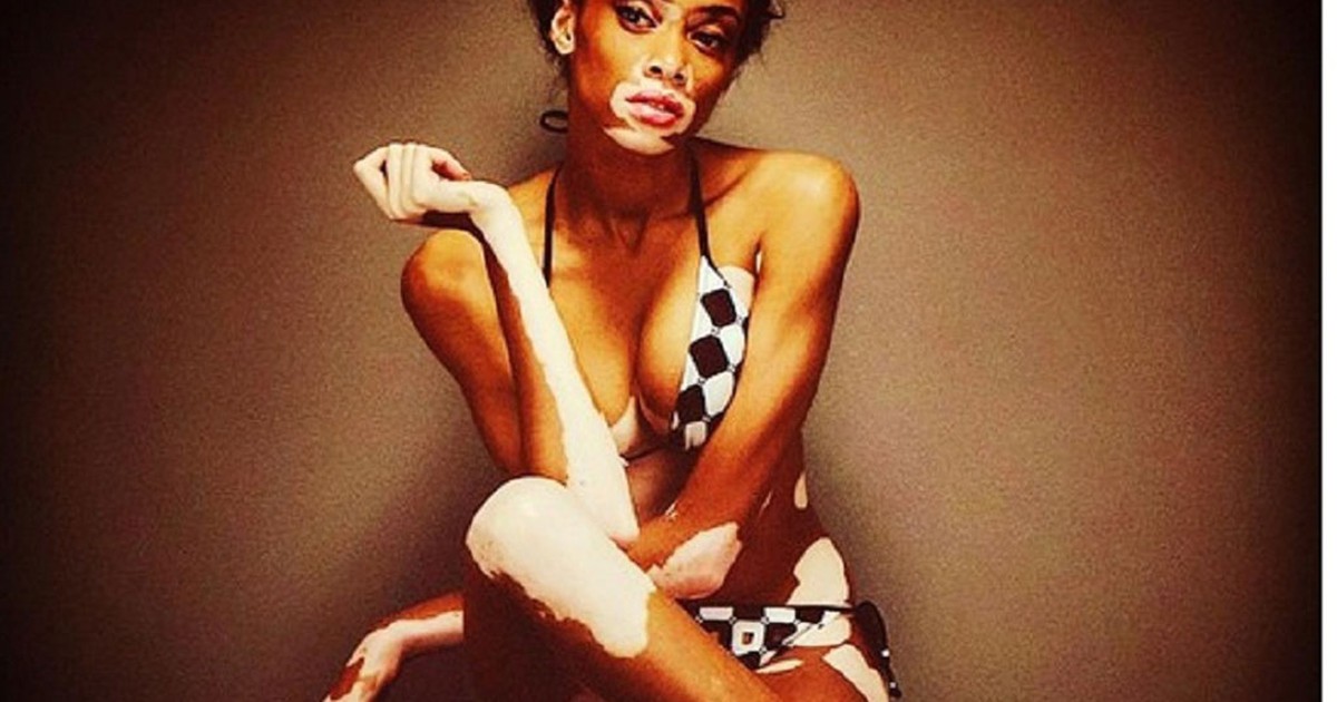 Chồng cũ Mariah Carey hẹn hò người mẫu bị bạch biến