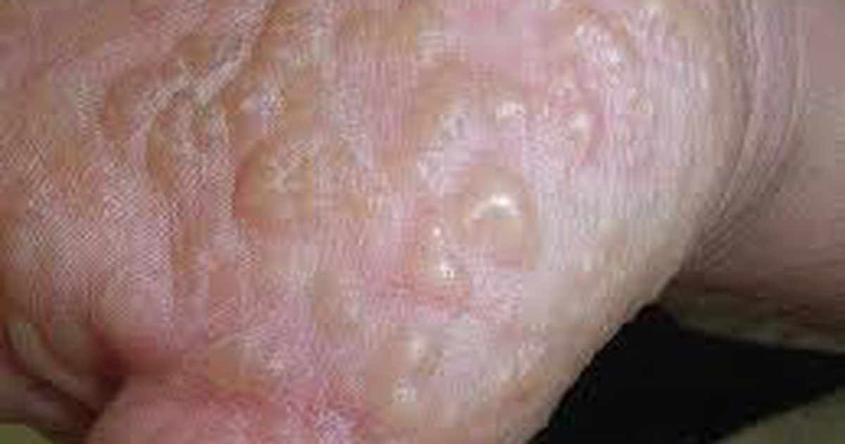 Cách điều trị bệnh chàm tổ đĩa không tái phát