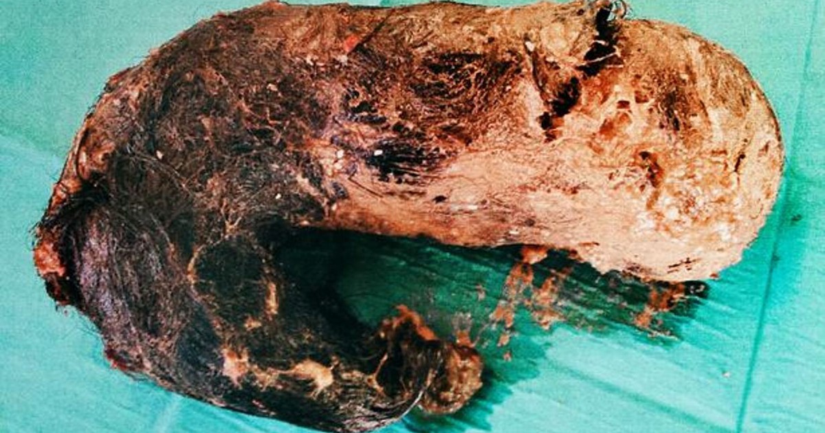 Búi tóc nặng 1,4 kg trong bụng của một cô gái vì thói quen nhai tóc