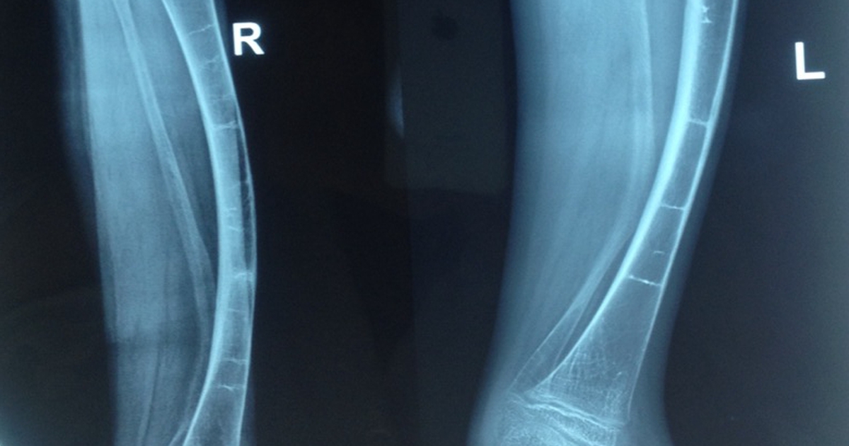 Bệnh viện tỉnh Khánh Hòa: Lần đầu mổ thành công cho bé trai bị xương thủy tinh