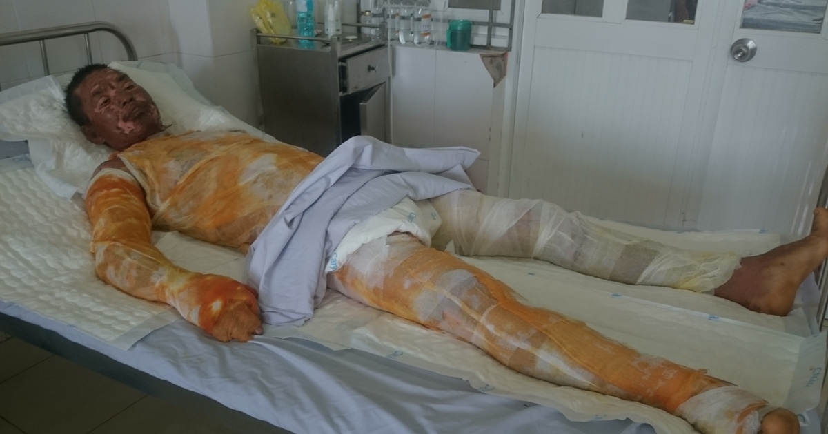 Lá lành đùm lá rách: Vợ chồng nghèo cùng bị bỏng nặng