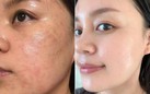 Da dầu mụn mùa nắng nóng ‘mê mẩn’ sản phẩm phục hồi này vì không bí da