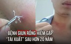 Bệnh giun rồng hiếm gặp 'tái xuất' tại Việt Nam sau hơn 20 năm: Cách để lấy giun khỏi cơ thể an toàn