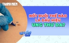 Cảnh báo những nốt ruồi bất thường là dấu hiệu của ung thư da