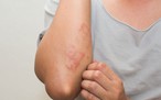 Gan nhiễm mỡ: Lưu ý những triệu chứng trên làn da