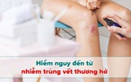 Tầm quan trọng của việc làm lành vết thương hở đúng cách