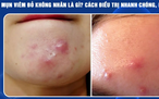Mụn sưng đỏ không nhân: Càng muốn nặn càng dễ thâm, chấm mụn thế nào mới đúng?