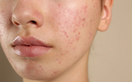 Review chấm mụn viêm mới Trioderma Intensive Acne Spot Gel: ‘Cứu tinh’ cho làn da
