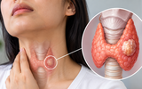 Người trẻ cũng mắc ung thư tuyến giáp: 4 yếu tố nguy cơ cần biết