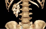 Sỏi thận san hô giống củ gừng nằm trong người nữ bệnh nhân