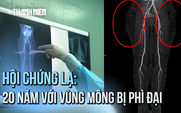 Cô gái trẻ mắc hội chứng lạ: 20 năm sống với vùng mông bị phì đại