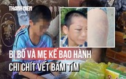 Toàn cảnh vụ bé trai nghi bị bố và mẹ kế bạo hành: Đã nhập viện với chi chít vết bầm tím