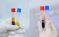 Đi khám thấy huyết thanh đục như sữa, dấu hiệu cảnh báo nguy cơ đột quỵ