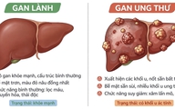 Biến đổi về màu da, nước tiểu cảnh báo ung thư gan