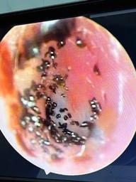 Ve chó ký sinh, làm tổ và sinh sản trong ống tai bé trai