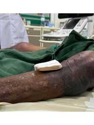Sốc nhiễm khuẩn, suy đa tạng sau khi ăn tiết canh