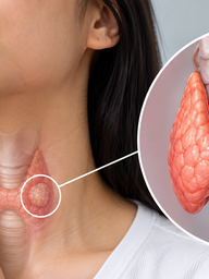 Người trẻ cũng mắc ung thư tuyến giáp: 4 yếu tố nguy cơ cần biết