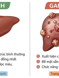 Biến đổi về màu da, nước tiểu cảnh báo ung thư gan