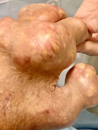 Người bị gout có nên ăn ức gà thay thế hoàn toàn thịt lợn, bò?