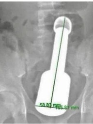 Chày kim loại kẹt trong trực tràng: Tuổi dậy thì và tâm lý 'một mình, thử xem sao'