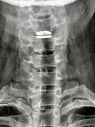 Sai lầm khi trị đau cổ vai gáy có thể gây liệt