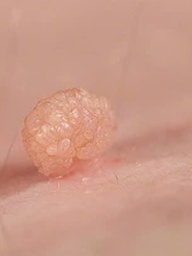 Tình dục không an toàn, nam bệnh nhân gần 70 tuổi mắc sùi mào gà