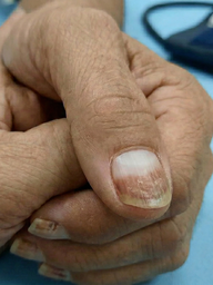 Dấu hiệu bệnh thận âm thầm có thể xuất hiện ở móng tay