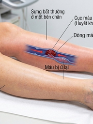 5 dấu hiệu cục máu đông ở chân có thể gây thuyên tắc phổi