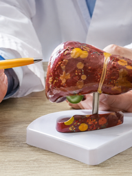 Vì sao bệnh gan nhiễm mỡ lại gia tăng ở những người không uống rượu?