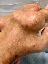 Các thực phẩm giúp kiểm soát axít uric ở người bệnh gout