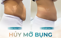 Bí quyết giảm béo nhanh chóng, an toàn với công nghệ Body Slim tại La Ratio